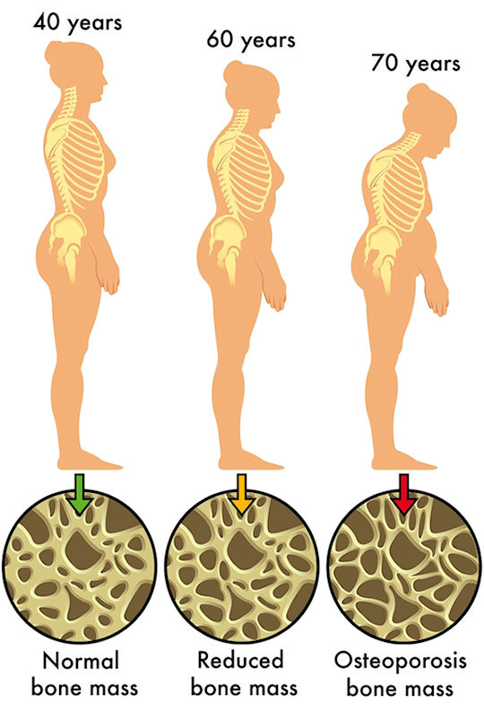 Osteoporosis